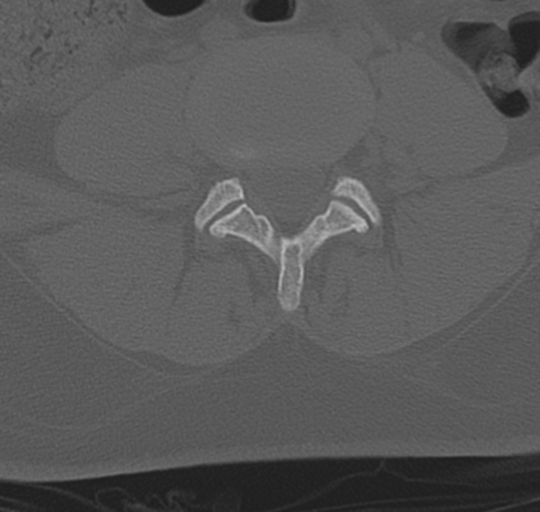 File:Normal lumbosacral CT (Radiopaedia 37923-39867 Axial bone window 68).png