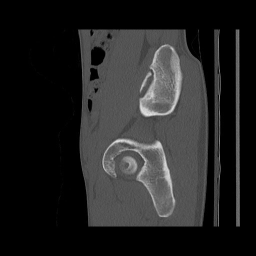 Normal pelvis (Radiopaedia 51473-57238 Sagittal bone window 45).jpg