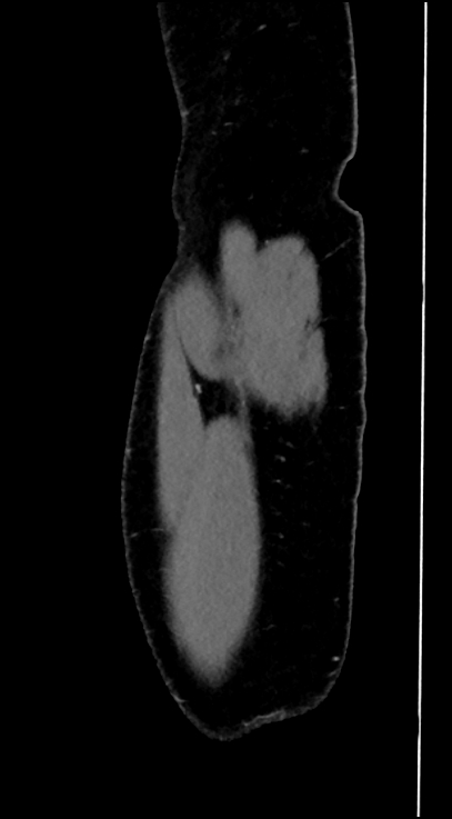 Normal pelvis CT angiogram (Radiopaedia 84966-100481 C 108).jpg
