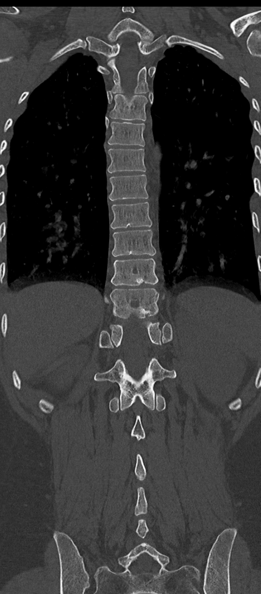 Normal thoracolumbar spine (Radiopaedia 43822-47309 Coronal bone window 62).png