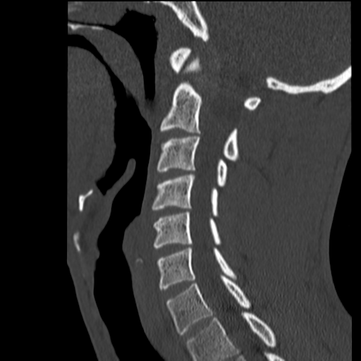 File:Normal trauma cervical spine (Radiopaedia 41017-43760 Sagittal bone window 18).png
