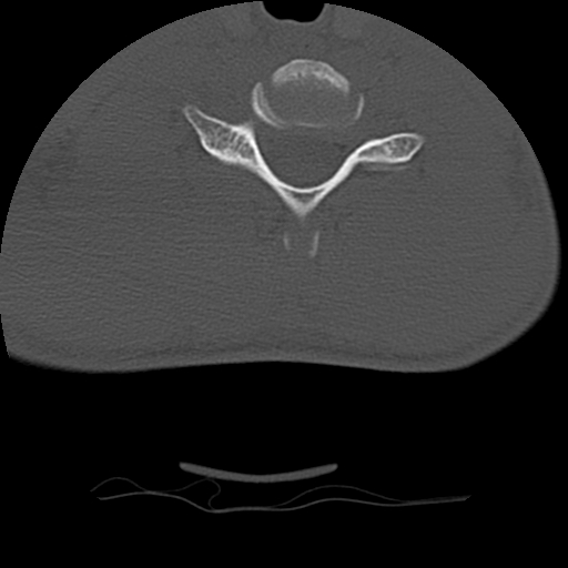 Normal trauma spine imaging (age 16) (Radiopaedia 45335-49358 Axial bone window 59).jpg