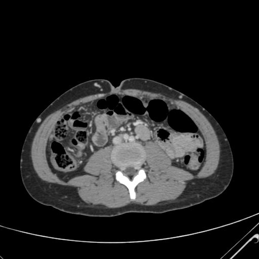 File:Nutmeg liver- Budd-Chiari syndrome (Radiopaedia 46234-50635 B 39).png