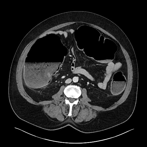 Obstructing sigmoid adenocarcinoma (Radiopaedia 58465-65619 A 90).jpg