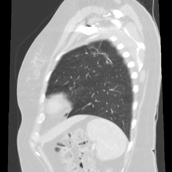 Obstructing typical carcinoid causing bronchoceles (Radiopaedia 50149-55476 Sagittal lung window 47).png