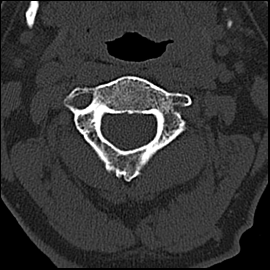 Occipital condyle fracture (type 1) (Radiopaedia 87670-104084 Axial bone window 29).jpg