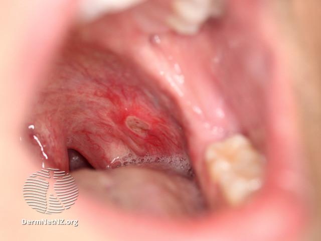 File:Oral Crohn disease (DermNet NZ systemic-oral-crohn).jpg