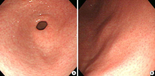 a,b)Endoscopic findings in an individual with eosinophilic gastroenteritis