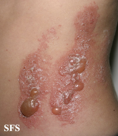 File:Phytophotodermatitis (Dermatology Atlas 30).jpg