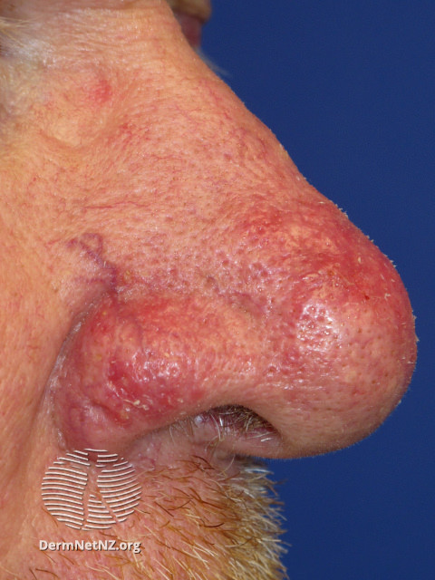 Rosacea (DermNet NZ acne-red-face-3643).jpg