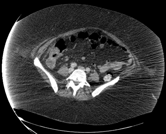 File:Abdominal abscess - pre and post percutaneous drainage (Radiopaedia 60209-67816 Axial 56).png