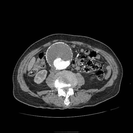 File:Abdominal aortic aneurysm (Radiopaedia 13341-13340 Axial C+ arterial phase 113).jpg