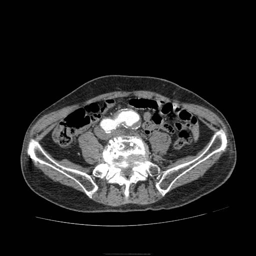 File:Abdominal aortic aneurysm (Radiopaedia 13341-13340 Axial C+ arterial phase 158).jpg