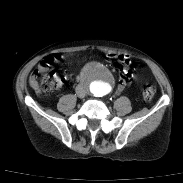 Abdominal aortic aneurysm (Radiopaedia 29248-29660 Axial C+ arterial phase 58).jpg