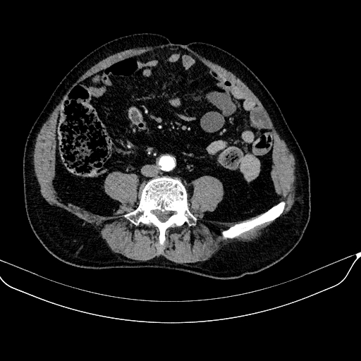 Abdominal aortic aneurysm (Radiopaedia 67117-76452 Axial C+ arterial phase 87).jpg