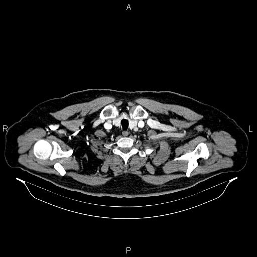 Abdominal aortic aneurysm (Radiopaedia 83094-97462 Axial renal cortical phase 6).jpg