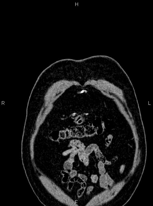 Abdominal aortic aneurysm (Radiopaedia 83094-97462 Coronal renal cortical phase 11).jpg