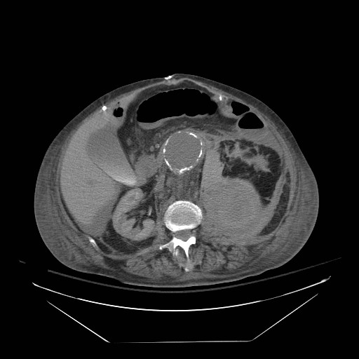 File:Abdominal aortic aneurysm - impending rupture (Radiopaedia 19233-19247 Axial non-contrast 78).jpg