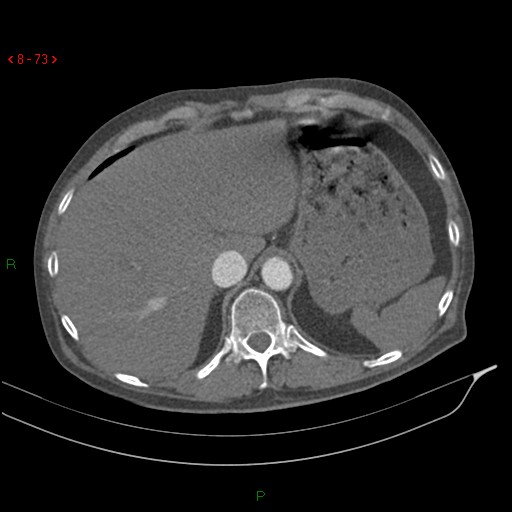 Abdominal aortic aneurysm rupture with aortocaval fistula (Radiopaedia 14897-14841 Axial C+ arterial phase 73).jpg