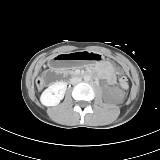 File:Abdominal multi-trauma - devascularised kidney and liver, spleen and pancreatic lacerations (Radiopaedia 34984-36486 Axial C+ delayed 35).png