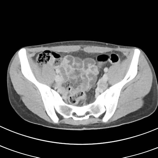 File:Abdominal multi-trauma - devascularised kidney and liver, spleen and pancreatic lacerations (Radiopaedia 34984-36486 Axial C+ delayed 63).png