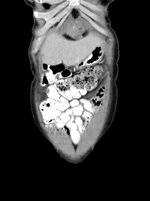 Abdominal wall and retroperitoneal tuberculosis (Radiopaedia 88137-104729 Coronal C+ portal venous phase 16).jpg
