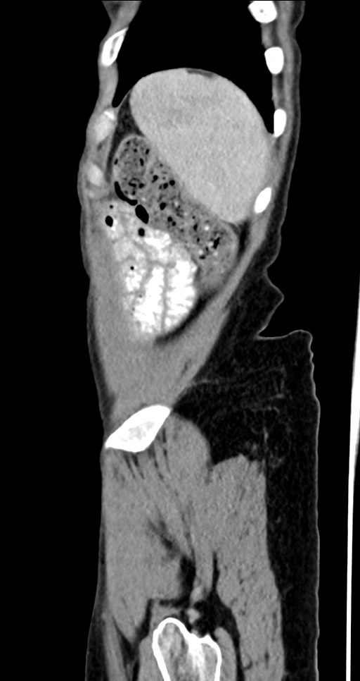 Abdominal wall and retroperitoneal tuberculosis (Radiopaedia 88137-104729 Sagittal C+ portal venous phase 22).jpg