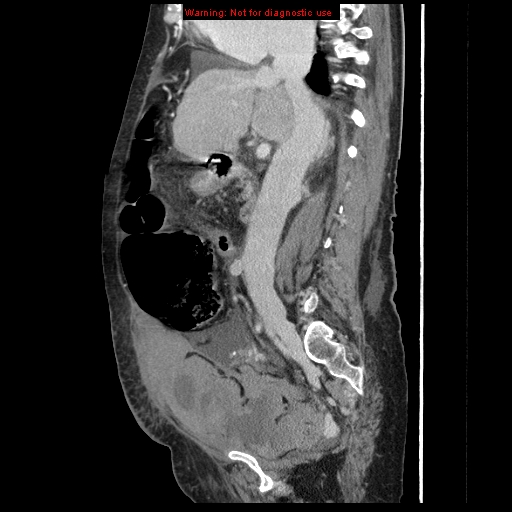 Abdominal wall hematoma (Radiopaedia 9427-10112 Sagittal C+ portal venous phase 62).jpg