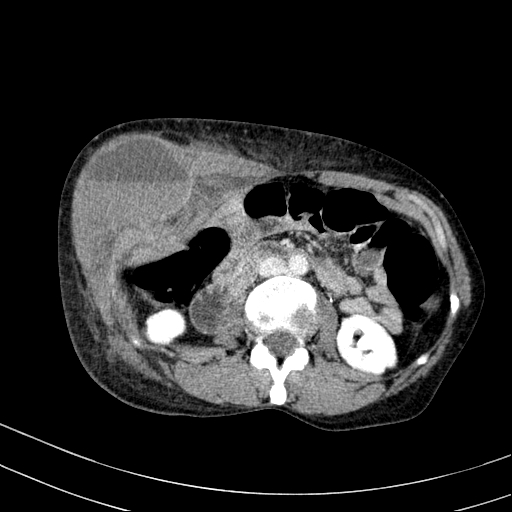 Abdominal wall hematoma with active bleeding (Radiopaedia 83915-99122 Axial contrast-enhanced CT 12).jpg