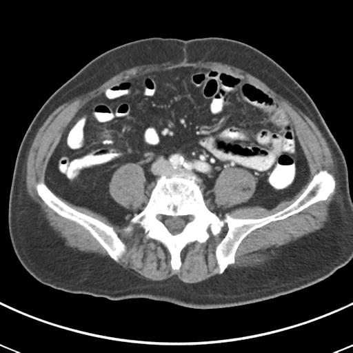 Abdominal wall metastasis from colorectal carcinoma (Radiopaedia 31016-31717 Axial C+ portal venous phase 49).jpg