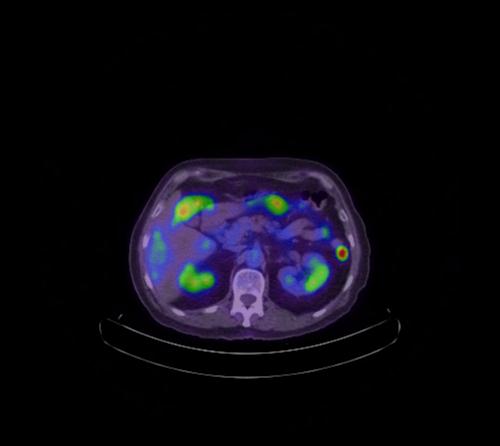 Abdominal wall metastasis from colorectal carcinoma (Radiopaedia 31016-31719 Axial 77).jpg