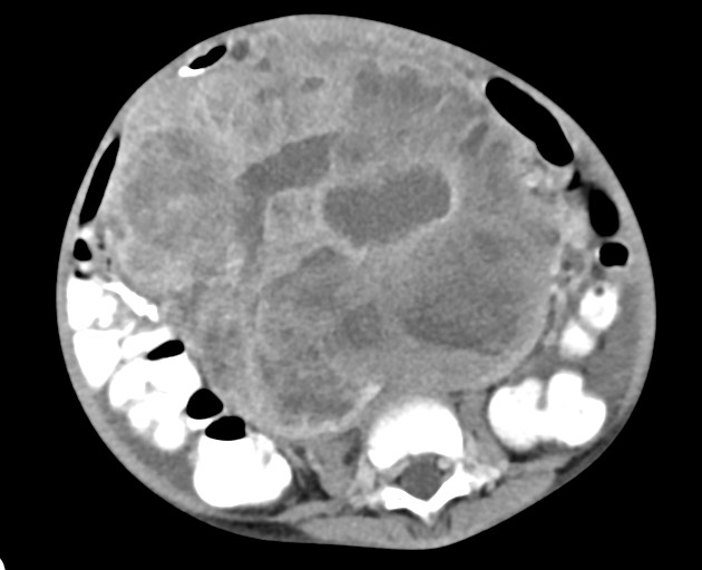 Abdominopelvic rhabdomyosarcoma (Radiopaedia 78356-90984 Axial C+ portal venous phase 102).jpg