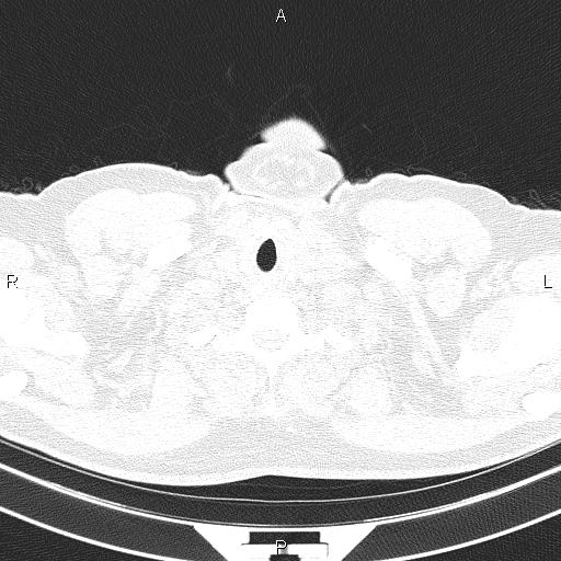 File:Aberrant right subclavian artery (Radiopaedia 87093-103354 Axial lung window 1).jpg