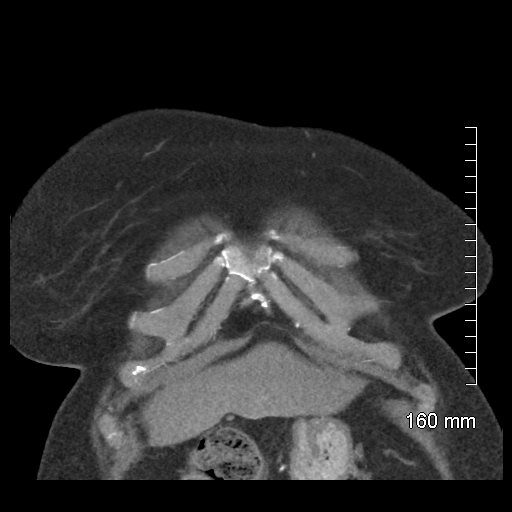 Aberrant right subclavian artery stenosis (Radiopaedia 52656-58670 B 16).jpg