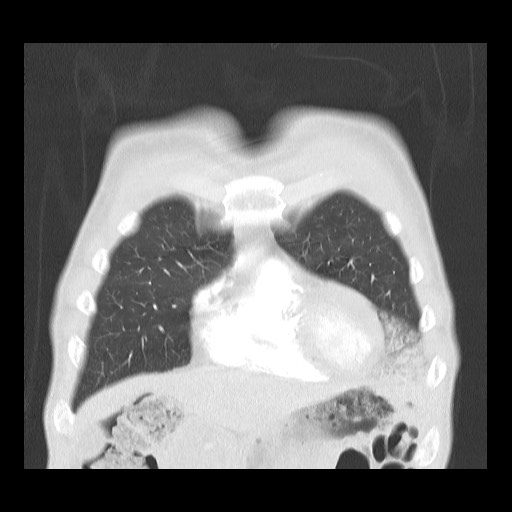 Accessory left horizontal fissure with lingular pneumonia (Radiopaedia 53763-59843 Coronal lung window 10).jpg