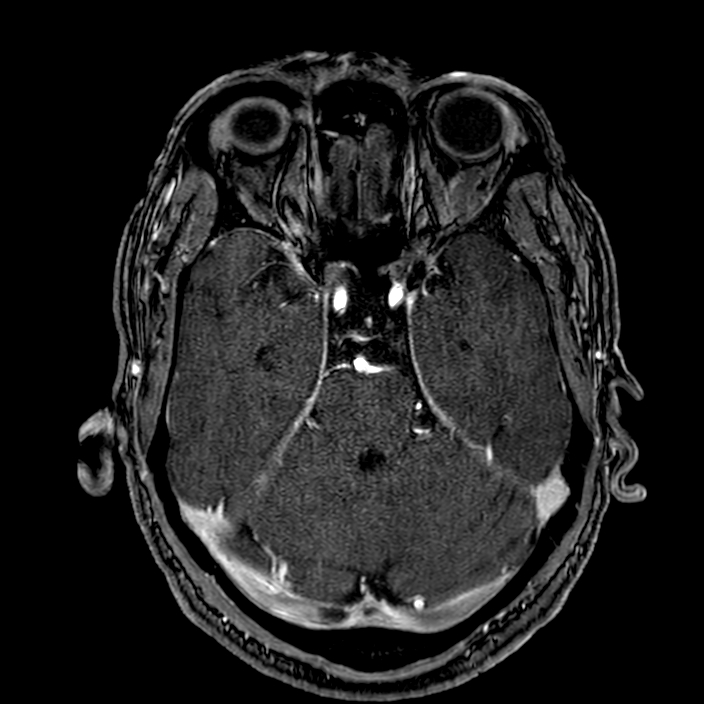 Accessory middle cerebral artery (Radiopaedia 73114-83828 Axial MRA 59).jpg