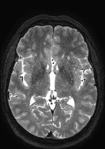 Accessory middle cerebral artery (Radiopaedia 73114-83828 Axial T2 75).jpg