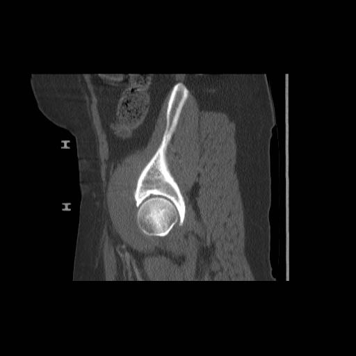 File:Acetabular fracture (Radiopaedia 13193-13212 Sagittal bone window 20).jpg