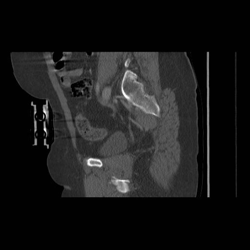 File:Acetabular fracture (Radiopaedia 13193-13212 Sagittal bone window 35).jpg