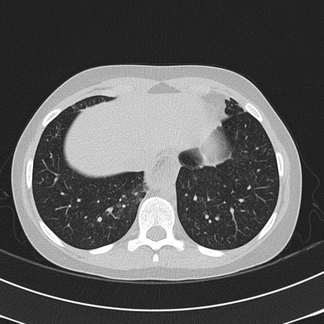 Achalasia (Radiopaedia 14946-14878 Axial lung window 64).jpg