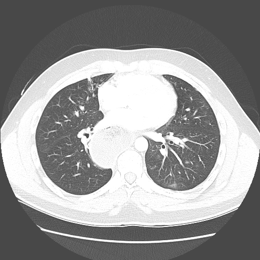File:Achalasia (Radiopaedia 52507-58417 Axial lung window 37).jpg