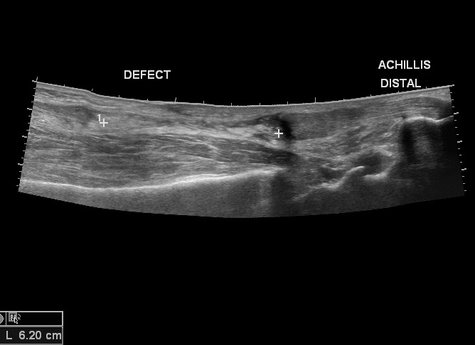 File:Achilles tendon tear (Radiopaedia 18551-18421 B 1).jpg
