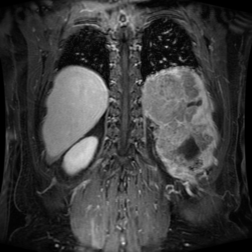 Acinar cell carcinoma of the pancreas (Radiopaedia 75442-86668 Coronal T1 C+ fat sat 47).jpg