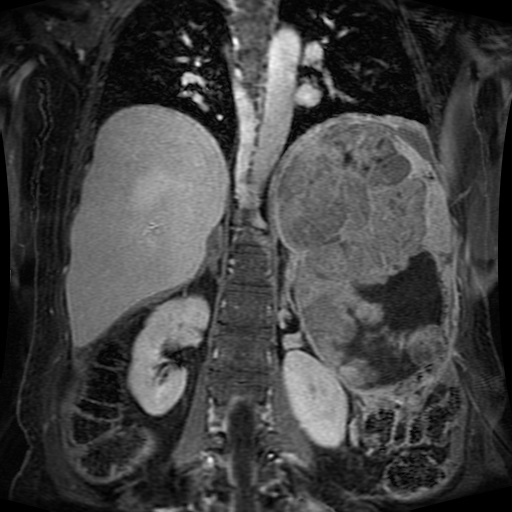 Acinar cell carcinoma of the pancreas (Radiopaedia 75442-86668 Coronal T1 C+ fat sat 74).jpg