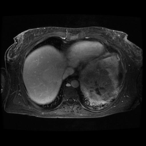 Acinar cell carcinoma of the pancreas (Radiopaedia 75442-86668 D 129).jpg
