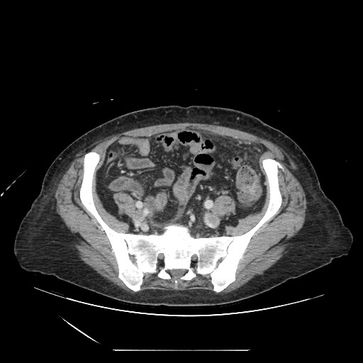 Acinar cell carcinoma of the pancreas (Radiopaedia 75442-86669 Axial C+ portal venous phase 110).jpg