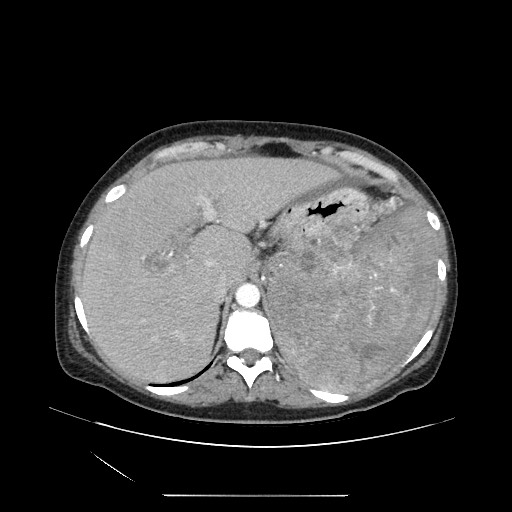 Acinar cell carcinoma of the pancreas (Radiopaedia 75442-86669 Axial C+ portal venous phase 28).jpg