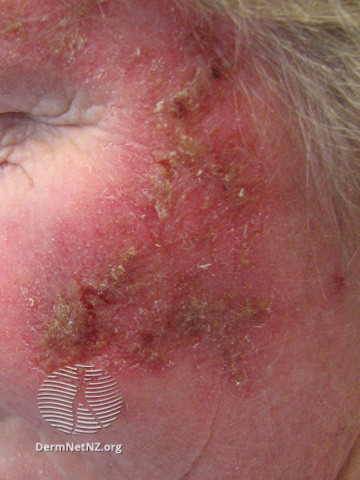 Actinic Keratoses treated with imiquimod (DermNet NZ lesions-ak-imiquimod-3758).jpg
