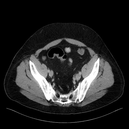 Acute-on-chronic pancreatitis (Radiopaedia 67286-76656 Axial C+ portal venous phase 66).jpg