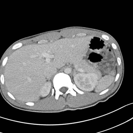 File:Acute appendicitis (Radiopaedia 32614-33572 Axial C+ portal venous phase 14).jpg